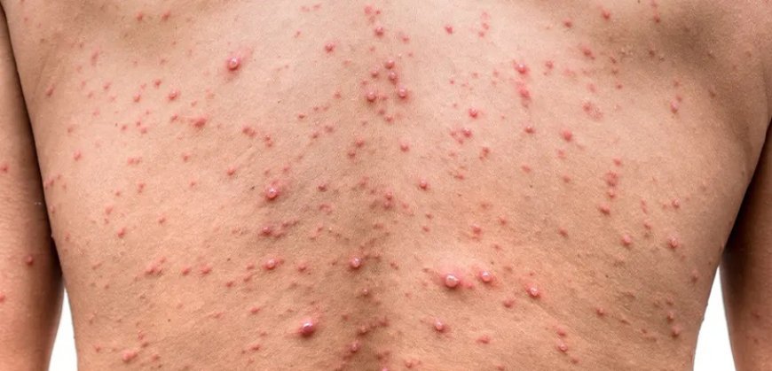 Monkeypox Outlook