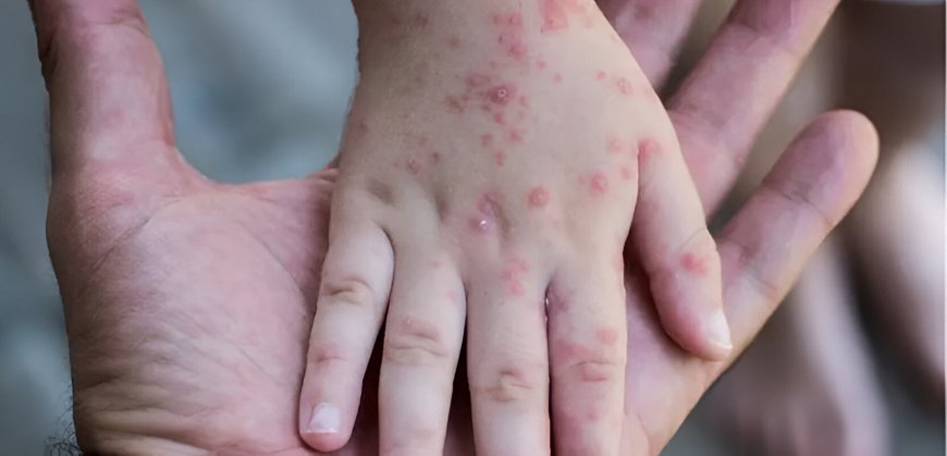 How Monkeypox Spreads Between People